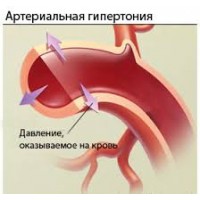 Результаты применения продукции Компании  ФитАпиСвит при гипертонии (отзывы)